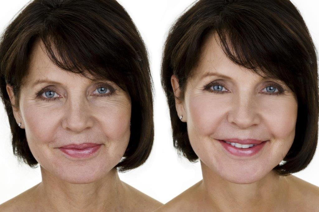 Kertalis helps reduce appearance of wrinkles